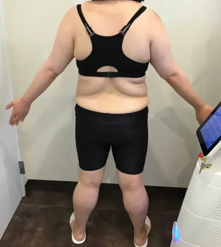 URARAクリニック　医療痩身 before画像4