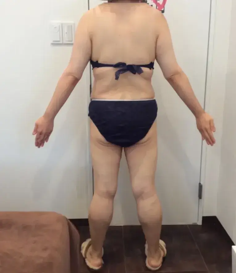 URARAクリニック　医療痩身 after画像4