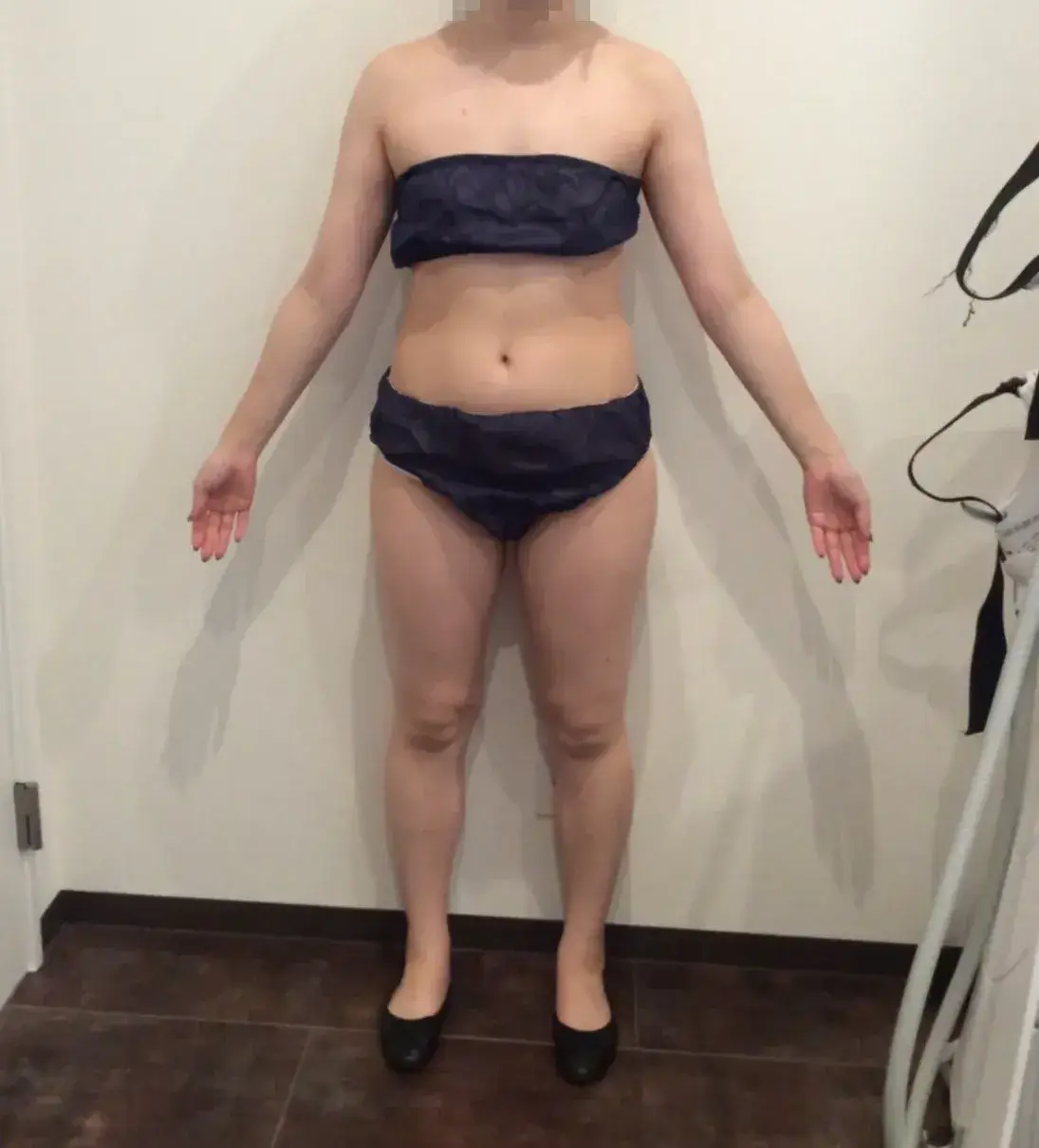 URARAクリニック　医療痩身　Before画像