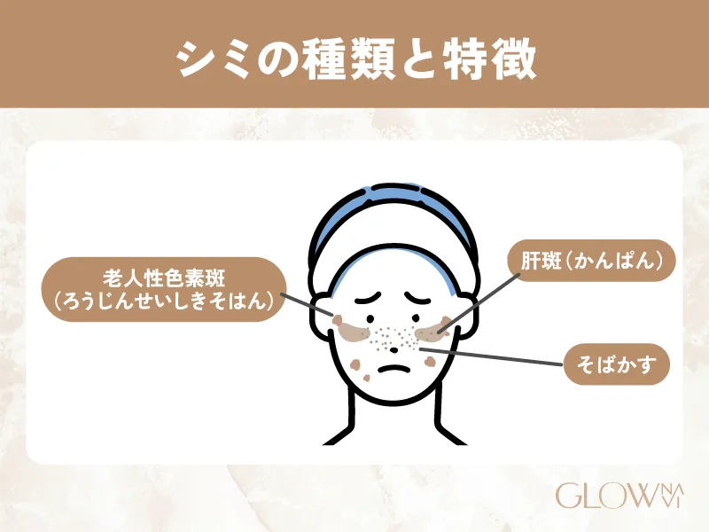 シミ取り 福岡