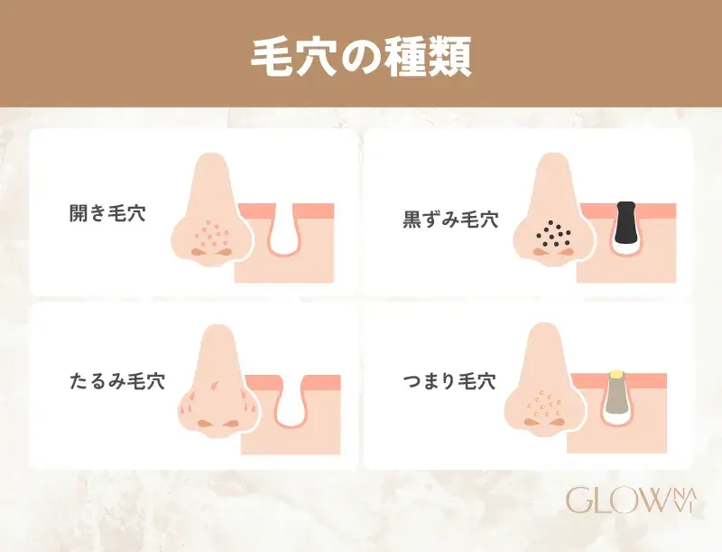 毛穴トラブルの種類