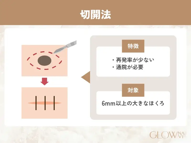 ほくろ除去　おすすめ