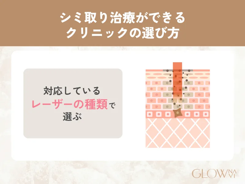 シミ取りレーザー　料金相場