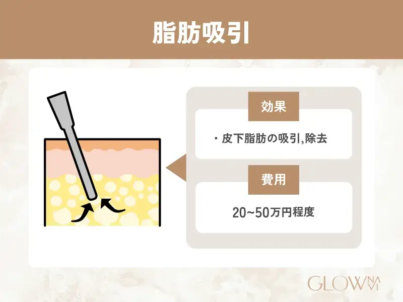 脂肪吸引　解説画像