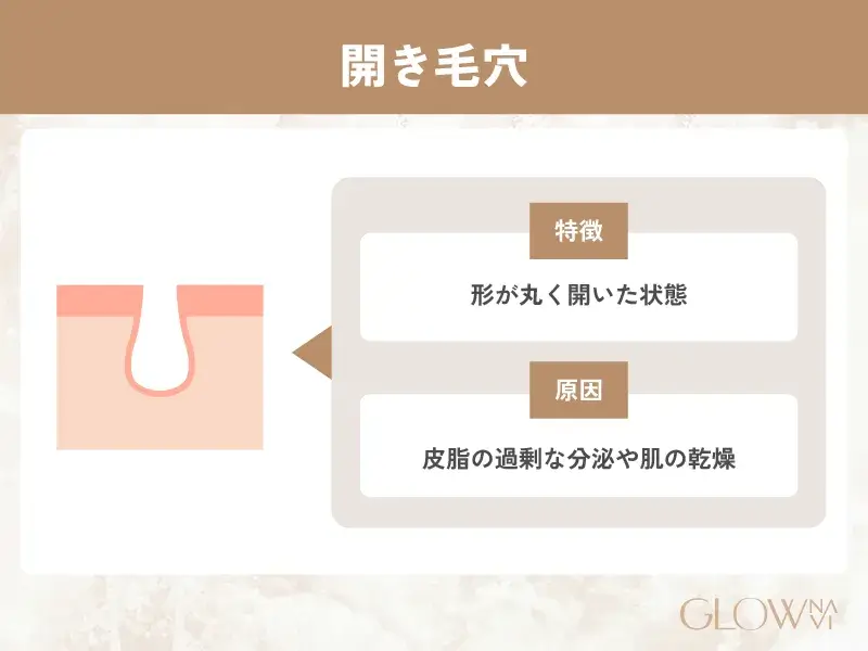 開き毛穴
