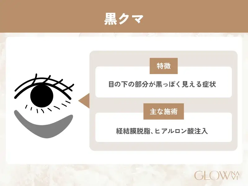 クマ取り　札幌