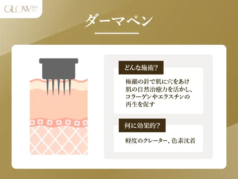 _H3_【クレーター状のニキビ跡に】ダーマペン