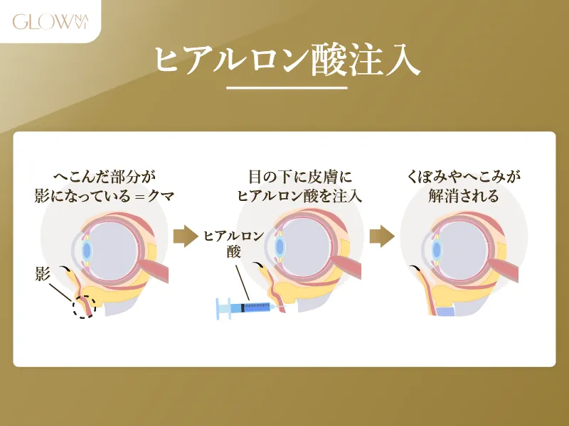 ヒアルロン酸注入