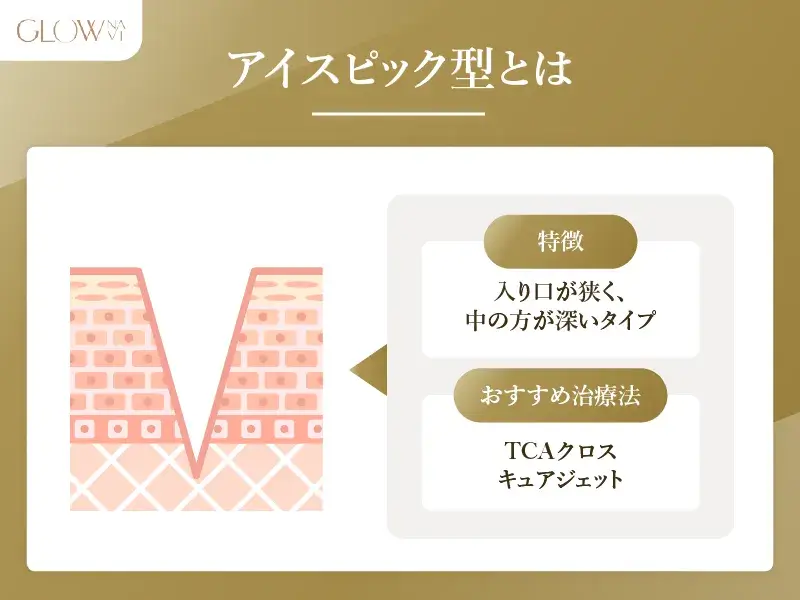 アイスピック型とは