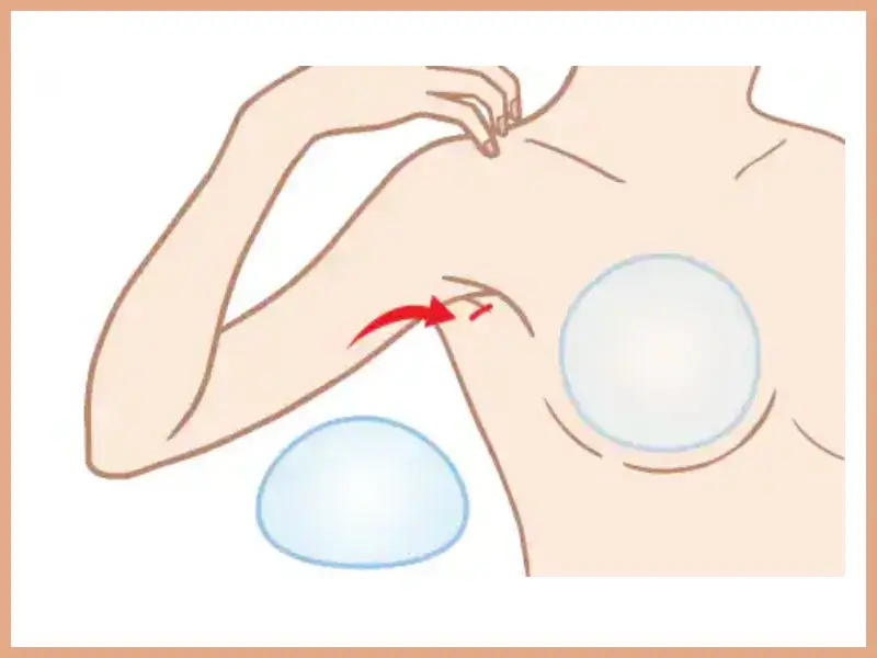 シリコンバッグ豊胸