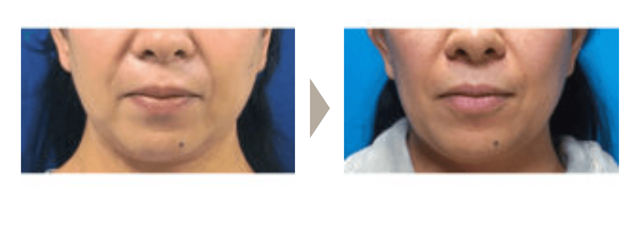 ガーデンクリニック　糸リフト　症例写真