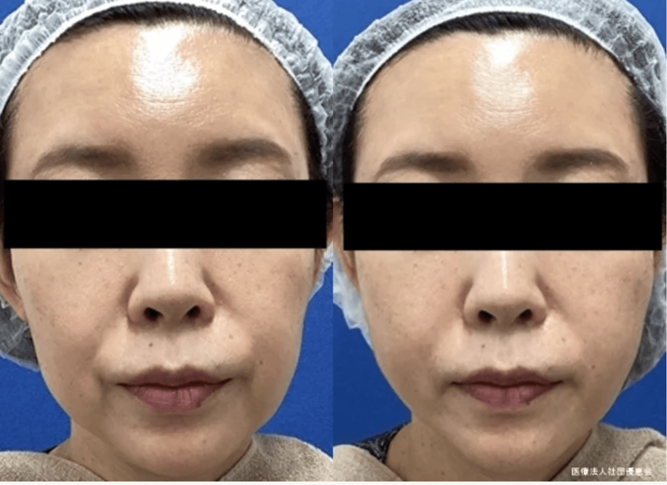 銀座よしえクリニック　糸リフト　症例写真