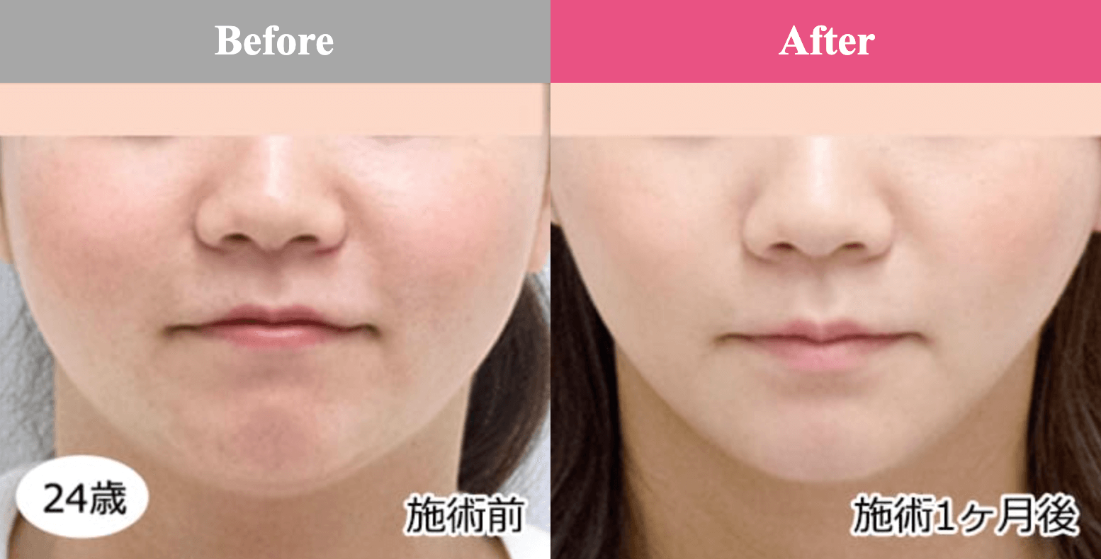 品川美容外科　糸リフト　症例写真