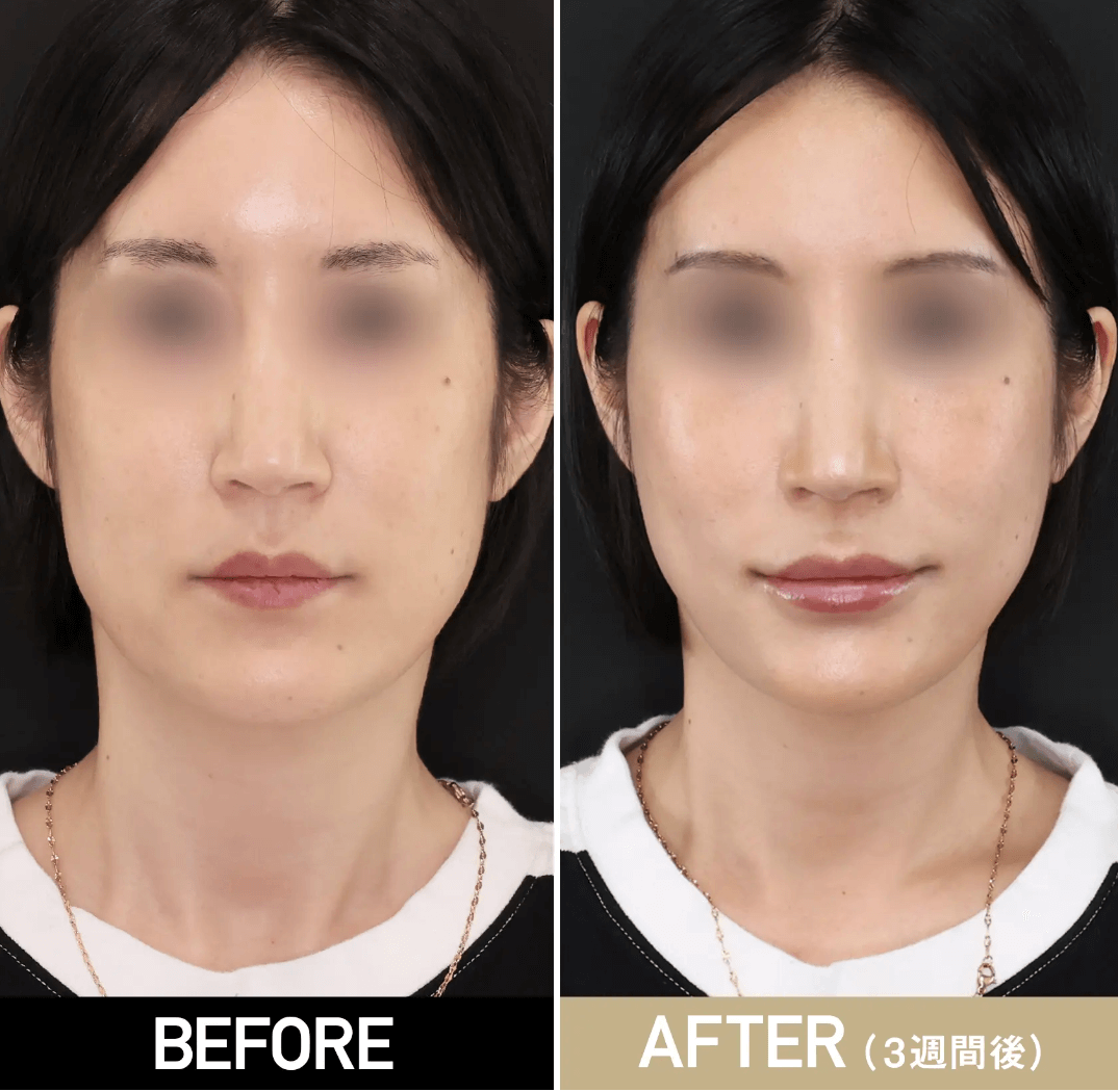 TAクリニック　糸リフト　症例写真