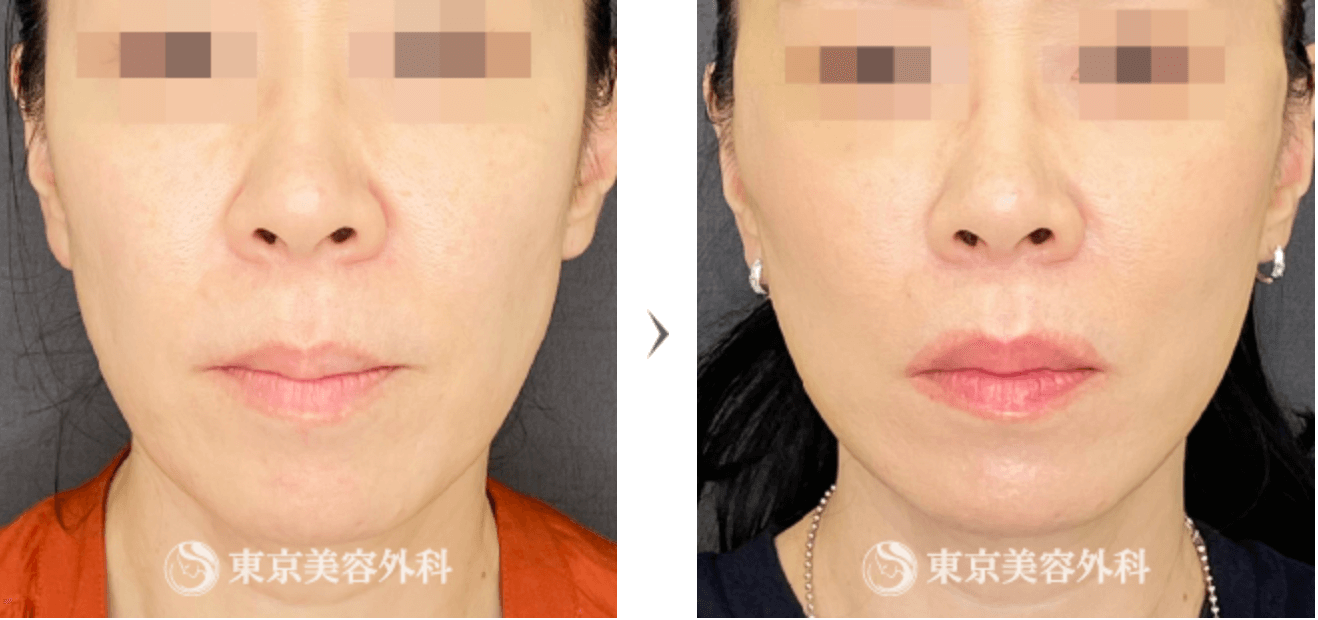 東京美容外科　糸リフト　症例写真