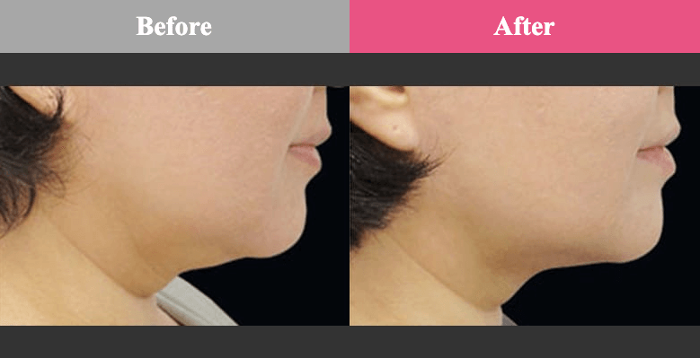 脂肪冷却 顔 品川美容外科