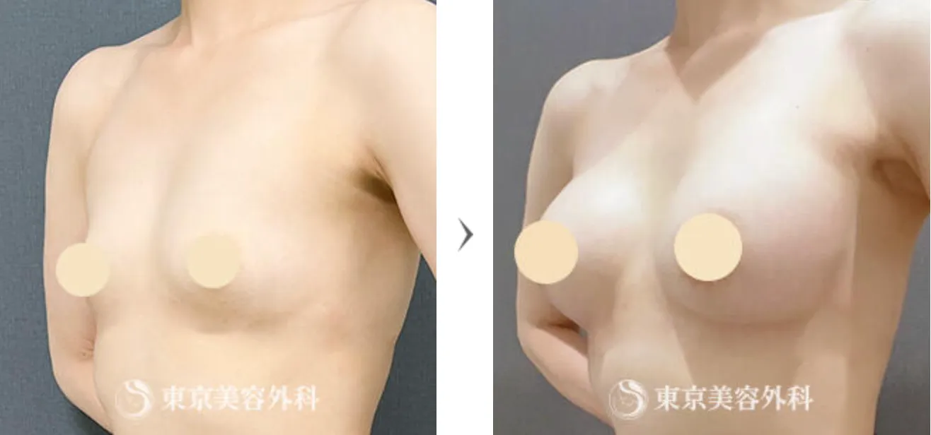 シリコンバッグ豊胸　東京美容外科