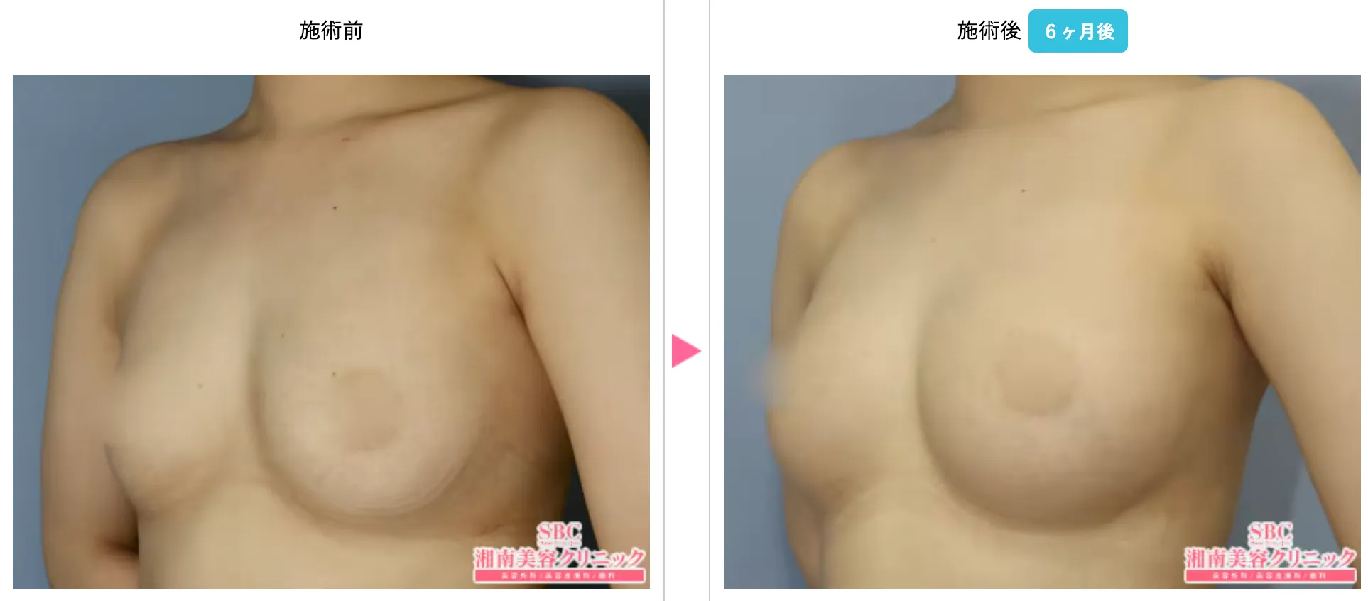 脂肪注入豊胸　症例写真