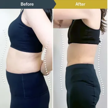 BSクリニック ダイエット症例