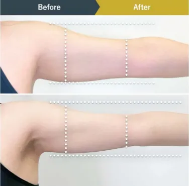 BSクリニック ダイエット症例