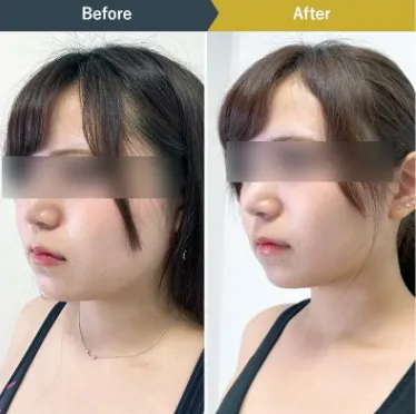 BSクリニック ダイエット症例