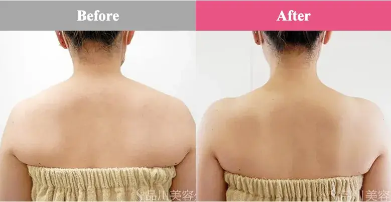 品川美容外科 肩ボトックス