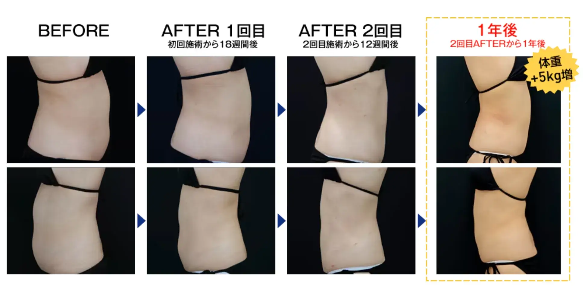 脂肪冷却　安い