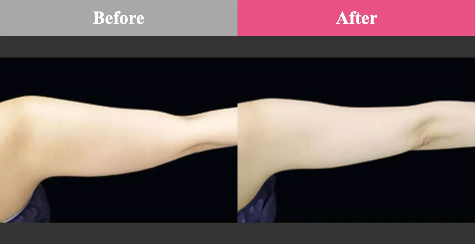 脂肪冷却　安い