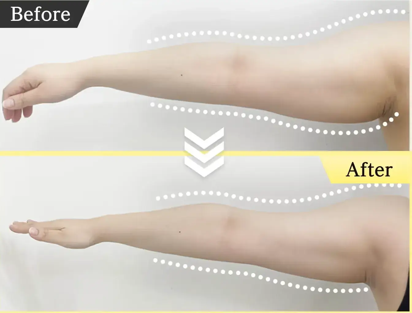 脂肪冷却　安い