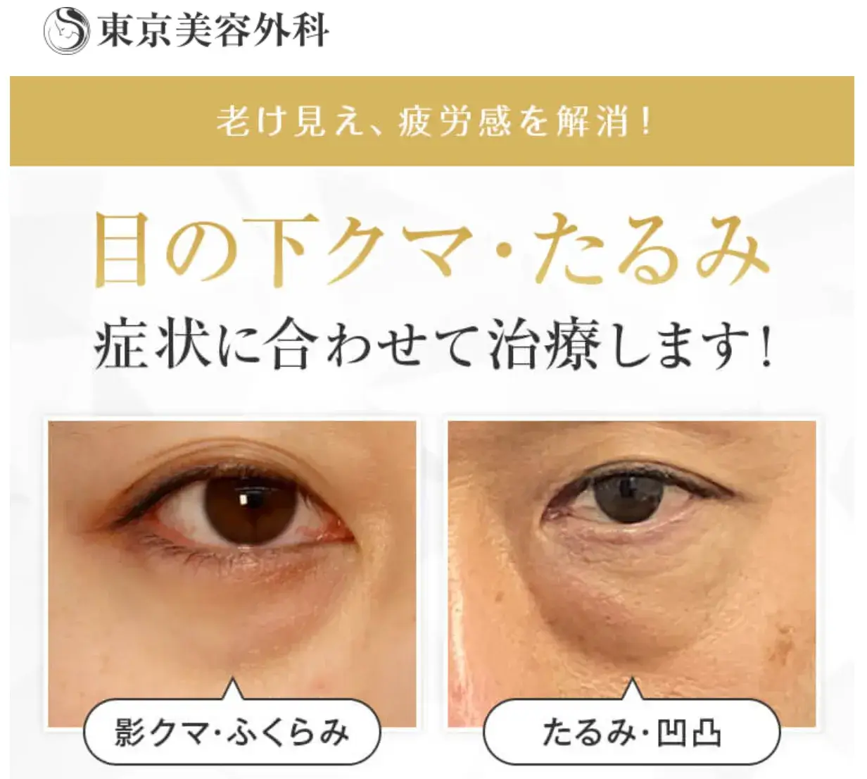 東京美容外科　クマ