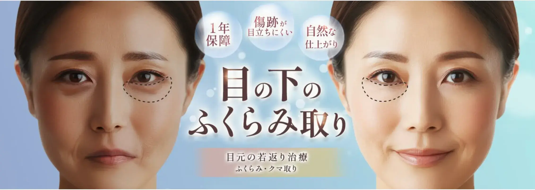 品川美容外科　クマ