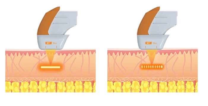 ウルトラフォーマーMPT