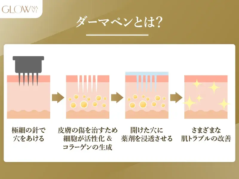 ダーマペンとは