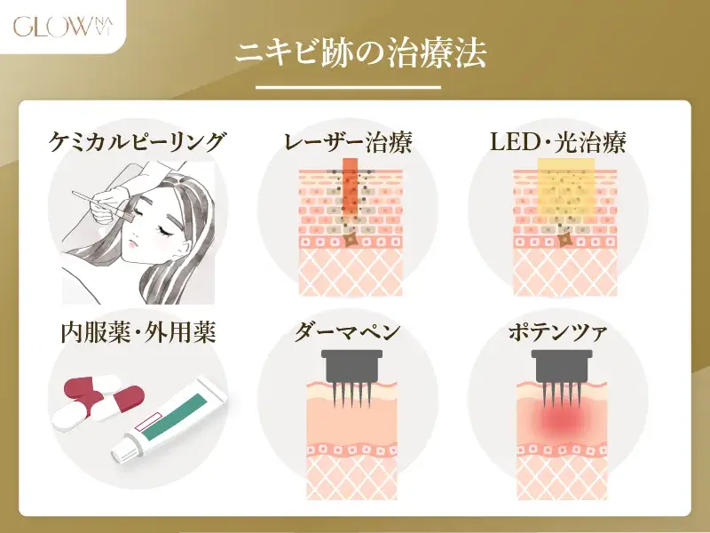 ニキビ跡の治療法