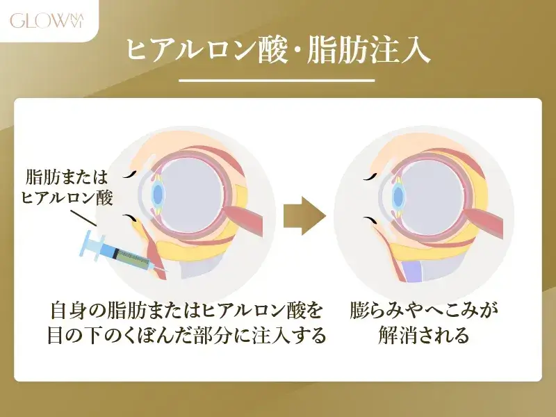 ヒアルロン酸・脂肪注入