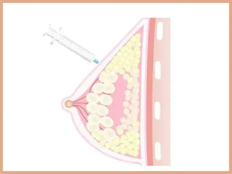 ヒアルロン酸豊胸