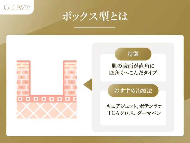 ボックス型とは