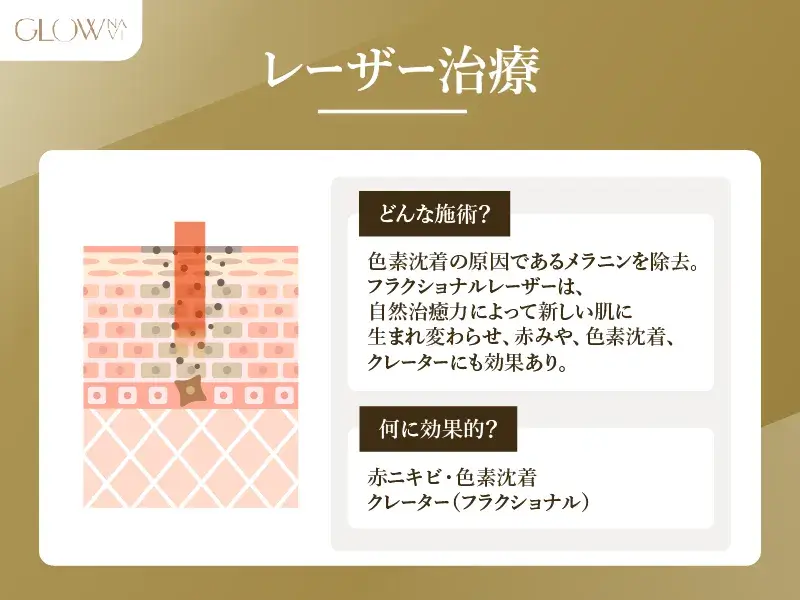 レーザー治療