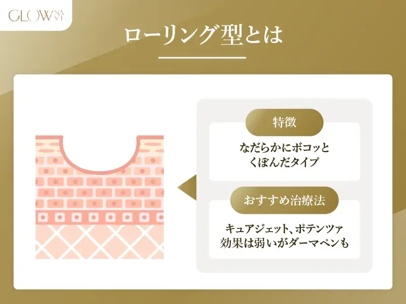 ローリング型とは