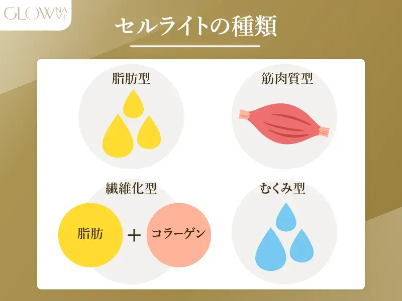 セルライトの種類