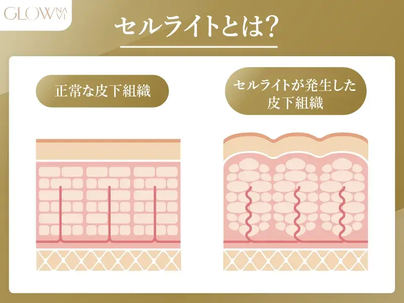 セルライトとは?