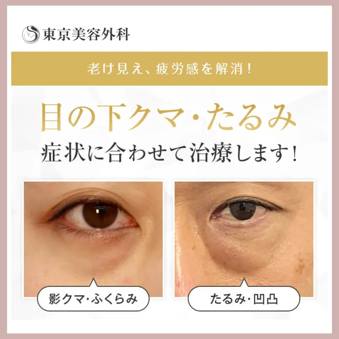 東京美容外科 クマ取り