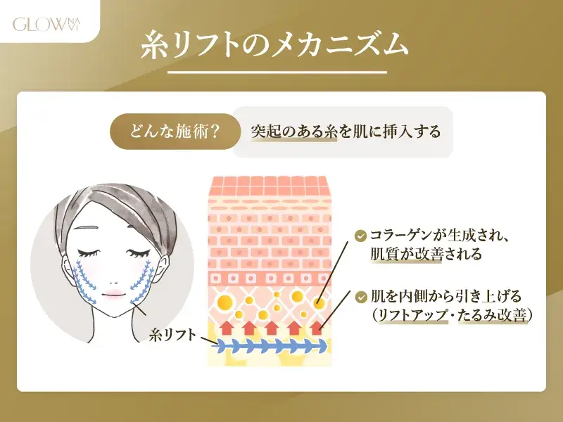 糸リフトのメカニズム