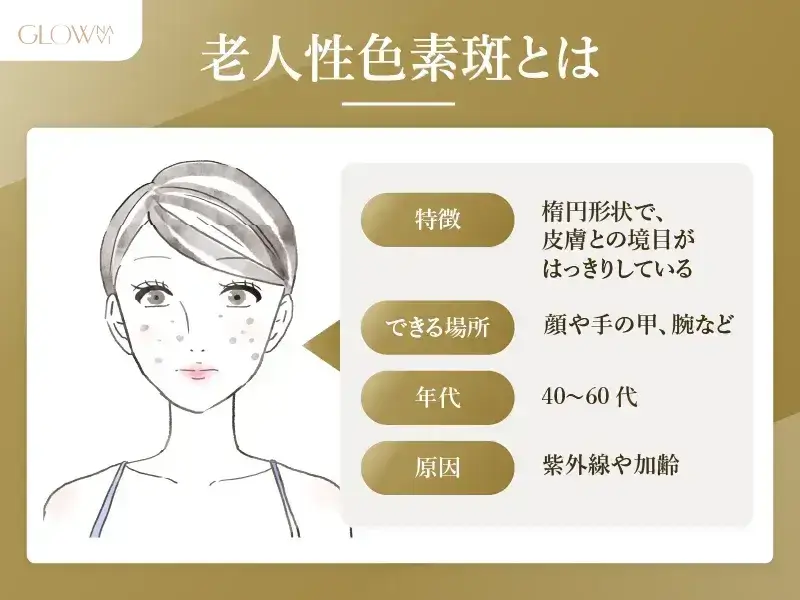 老人性色素沈着とは