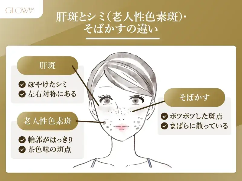 肝斑とシミ・そばかすの違い