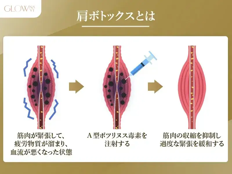 肩ボトックスとは