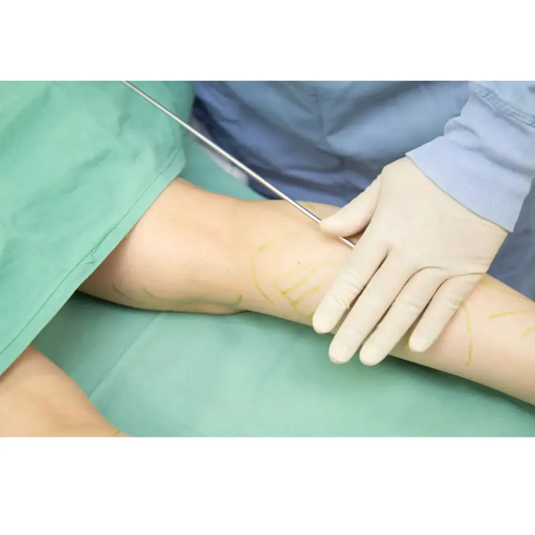 医療ダイエット 脂肪吸引