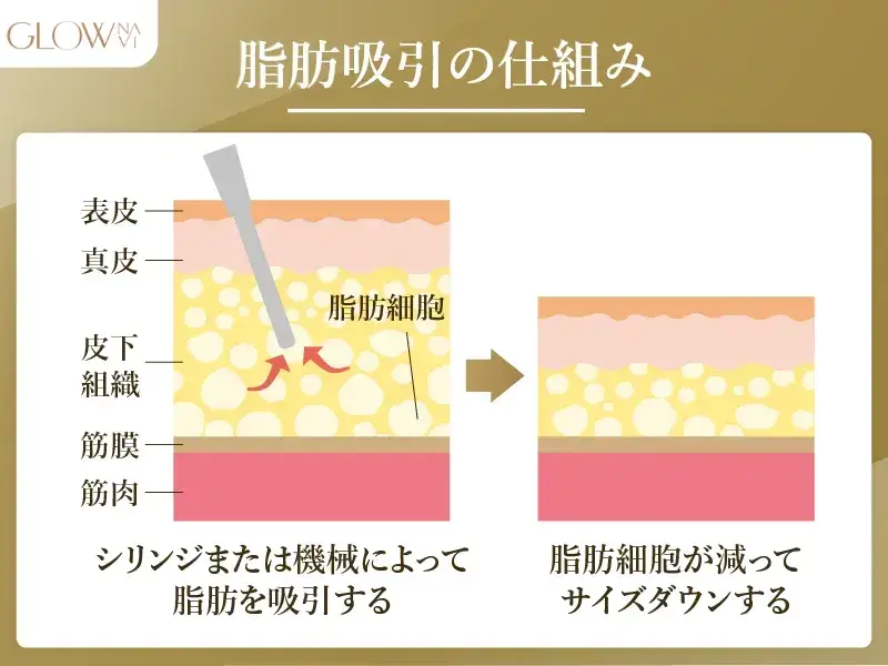 脂肪吸引の仕組み　解説画像