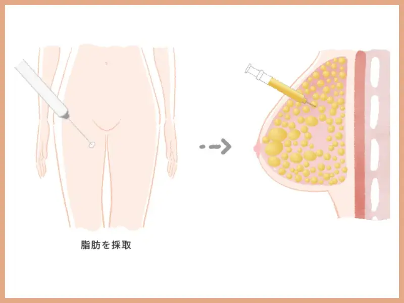 脂肪細胞豊胸