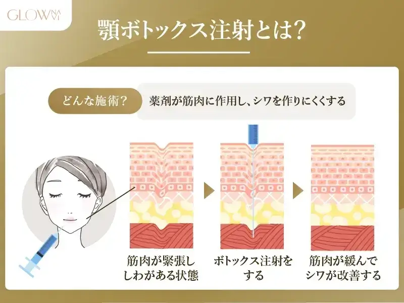 顎ボトックスとは